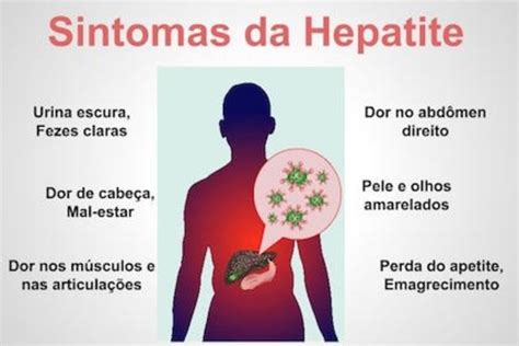 surto de hepatite aguda sintomas